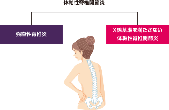 体軸性脊椎関節炎とは？