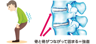 強直
