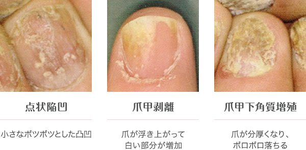 乾癬の爪症状