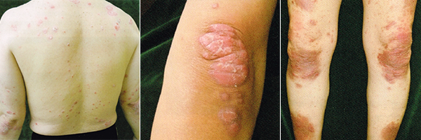 赤皮症性乾癬の症状