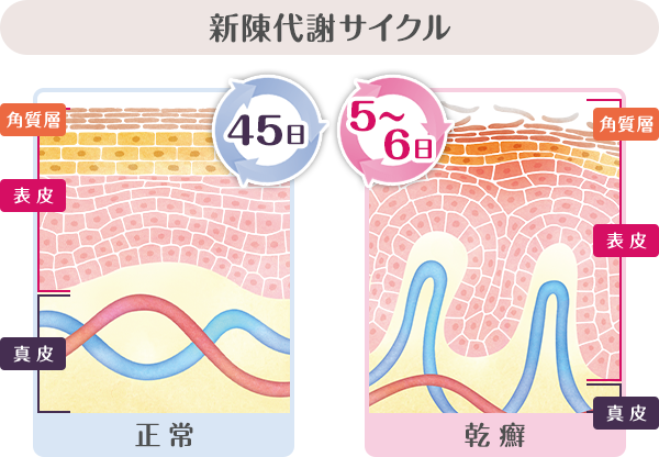 乾癬患者さんと正常な人の皮膚の新陳代謝サイクル