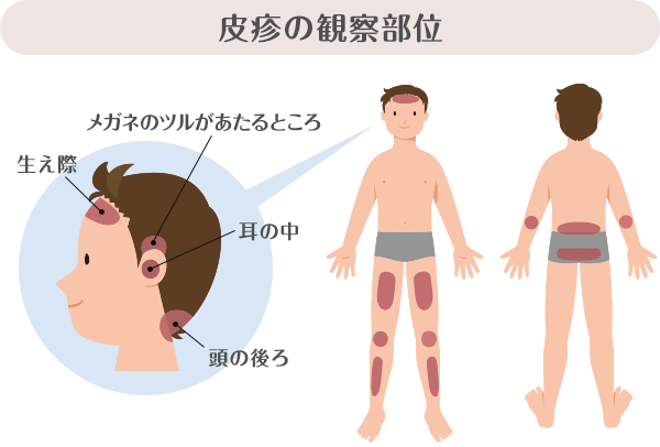皮疹の観察部位