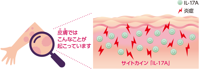 乾癬の炎症(イメージ図)