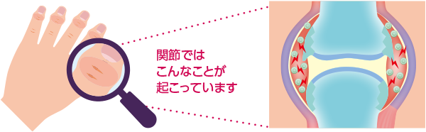 関節症性乾癬（乾癬性関節炎）の炎症（イメージ図）