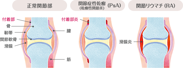 乾癬性関節炎付着部炎はどのように診断されますか?