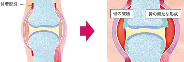 付着部炎の進行による骨の破壊と新たな形成