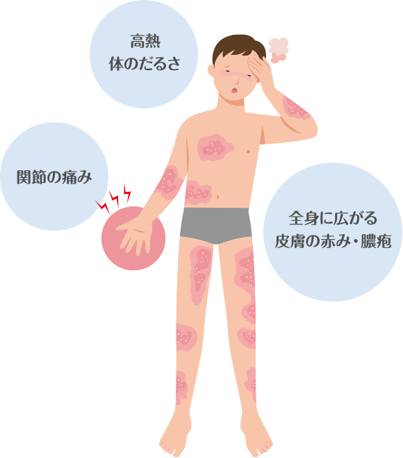 イメージ：膿疱性乾癬の症状