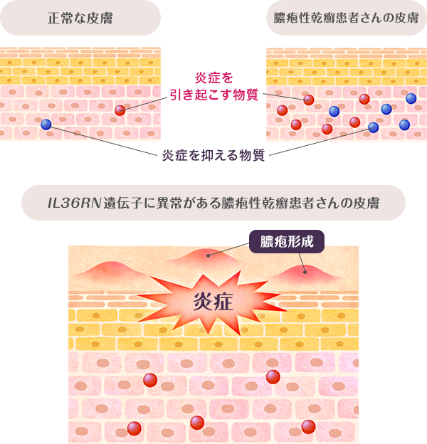 図：IL36RN 遺伝子異常がある膿疱性乾癬患者さんの皮膚の場合