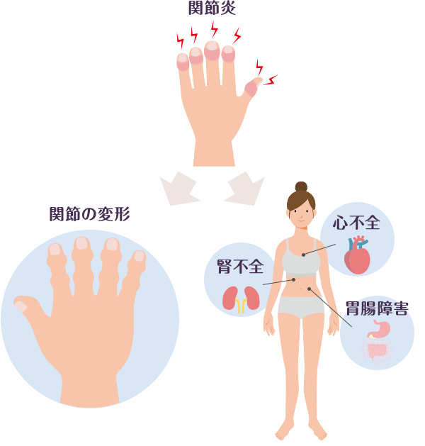 イメージ：合併症