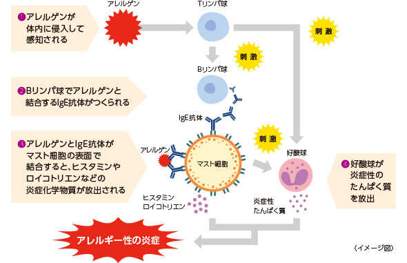 1.アレルゲンが体内に侵入して感知される 2.Bリンパ球でアレルゲンと結合するIgE抗体がつくられる 3.アレルゲンとIgE抗体がマスト細胞の表面で結合すると、ヒスタミンやロイコトリエンなどの炎症化学物質が放出される 4.好酸球が炎症性のたんぱく質を放出 ⇒ [アレルギー性の炎症] <イメージ図>