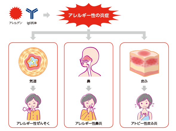 アレルゲン、IgE抗体 ⇒ [アレルギー性の炎症]（アレルギー性ぜんそく、アレルギー性鼻炎、アトピー性皮ふ炎）
