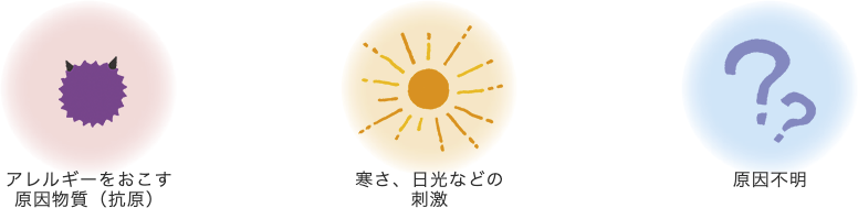 アレルギーをおこす原因物質（抗原）・寒さ、日光などの刺激・原因不明