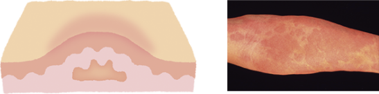 イメージ：皮膚の血管と神経に作用し、血管拡張、血漿成分漏出により、膨疹ができる