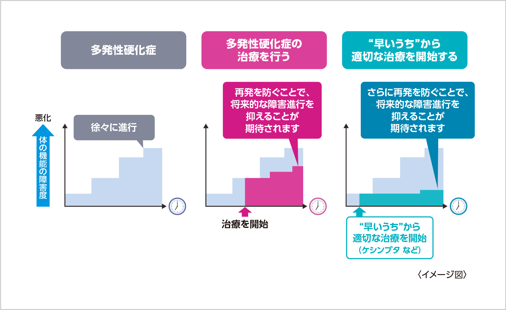 多発性硬化症の早期治療の大切さ