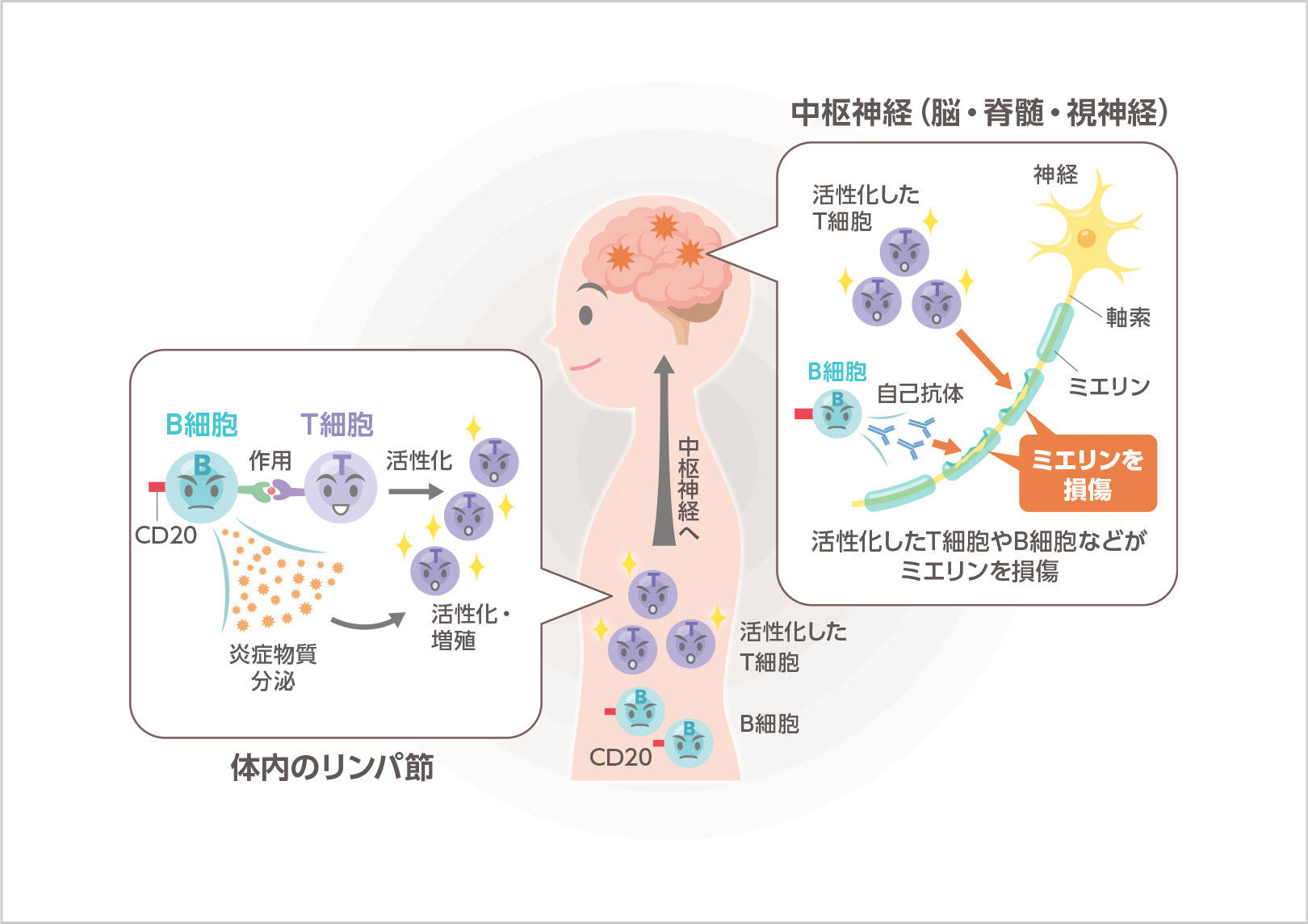 多発性硬化症（イメージ図）