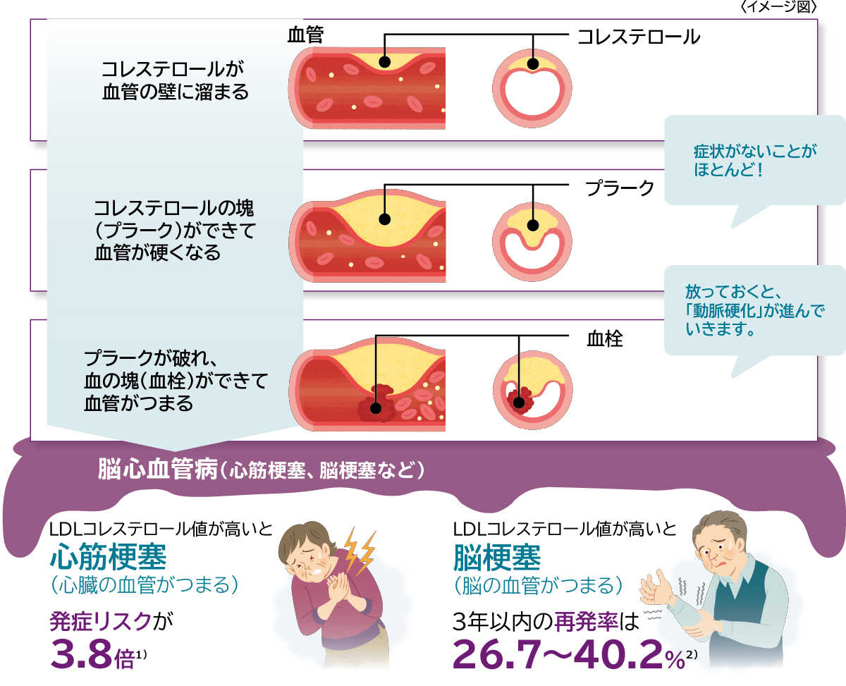 コレステロールが血管の壁に溜まる→コレステロールの塊(プラーク)ができて血管が硬くなる 症状がないことがほとんど！→プラークが破れ、血の塊(血栓)ができて血管がつまる 放っておくと、「動脈硬化」が進んでいきます。→　脳心血管病(心筋梗塞、脳梗塞など)　LDLコレステロール値が高いと心筋梗塞(心臓の血管がつまる)発症リスクが3.8倍 2)　LDLコレステロール値が高いと腦梗塞(脳の血管がつまる)3年以内の再発率は26.7～40.2% 3)