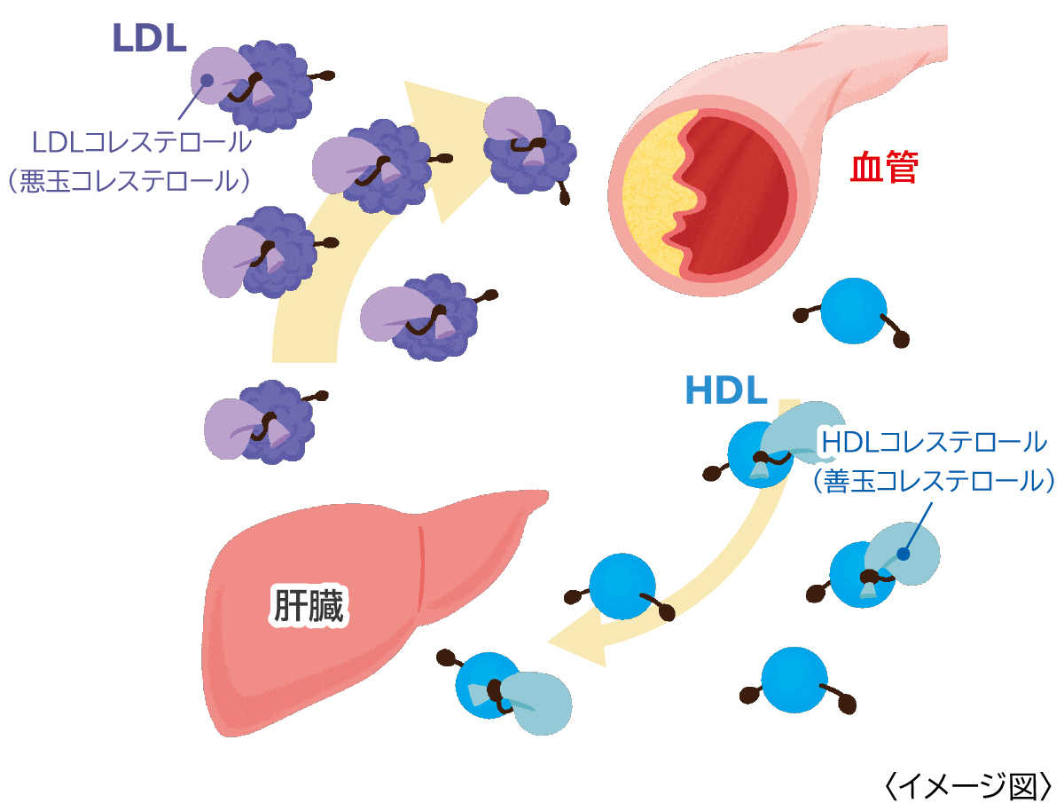 イメージ図：高コレステロール血症とはなんですか？