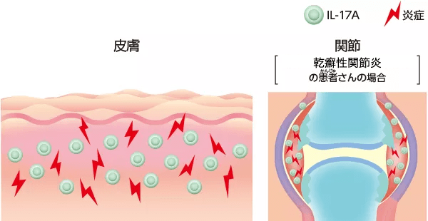 乾癬の症状