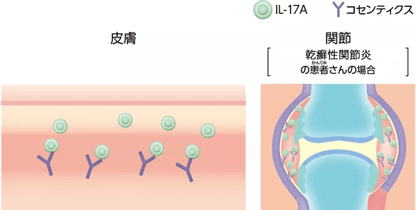 コセンティクスで治療したとき