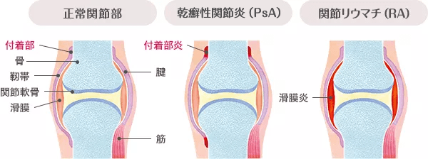 付着部炎と滑膜炎