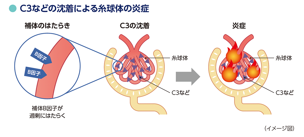 イメージ図：C3などの沈着による糸球体の炎症