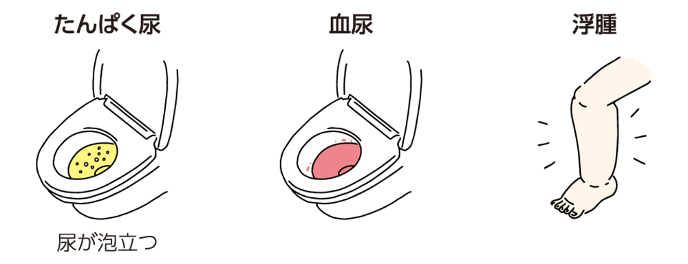 イラスト：尿が泡立つ、血尿、浮腫