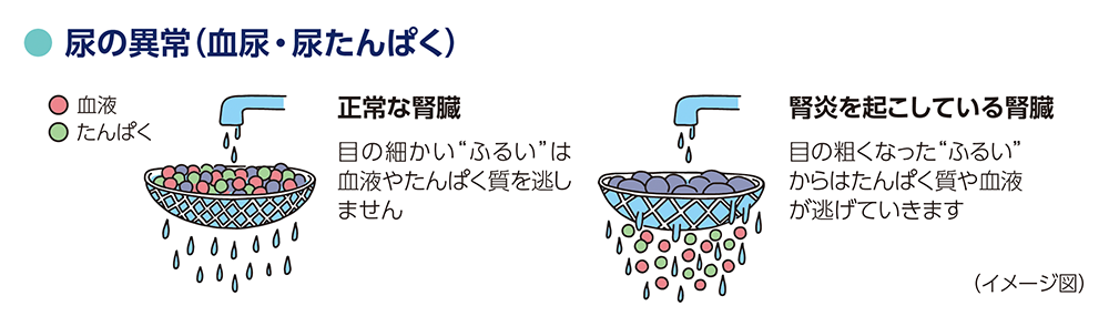 イメージ図：尿の異常（血尿・尿たんぱく） 正常な腎臓・目の細かい“ふるい”は血液やたんぱく質を逃しません。 腎炎を起こしている腎臓・目の粗くなった“ふるい”からはたんぱく質や血液が逃げていきます。