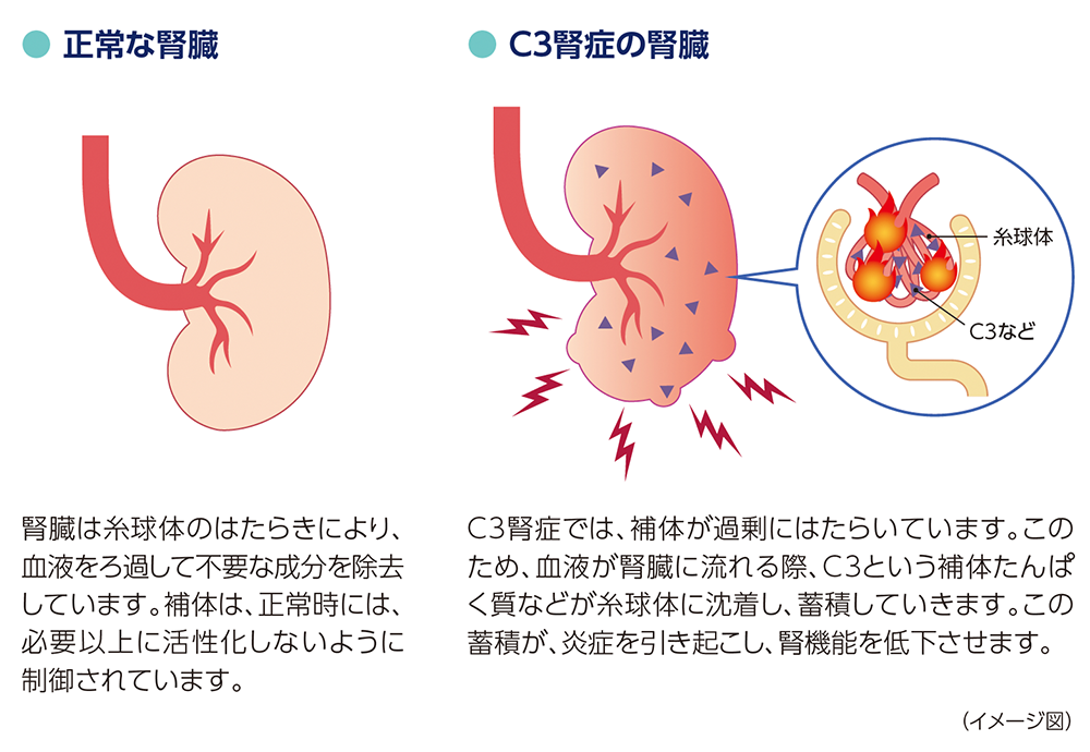 イメージ図： 正常な腎臓・腎臓は糸球体のはたらきにより、血液をろ過して不要な成分を除去しています。補体は、正常時には、必要以上に活性化しないように制御されています。 C3腎症の腎臓・C3腎症では、補体が過剰にはたらいています。このため、血液が腎臓に流れる際、C3という補体たんぱく質などが糸球体に沈着し、蓄積していきます。この蓄積が、炎症を引き起こし、腎機能を低下させます。