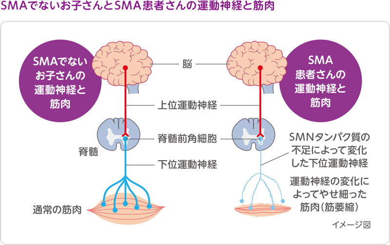 図:SMAでないお子さんとSMA患者さんの運動神経と筋肉