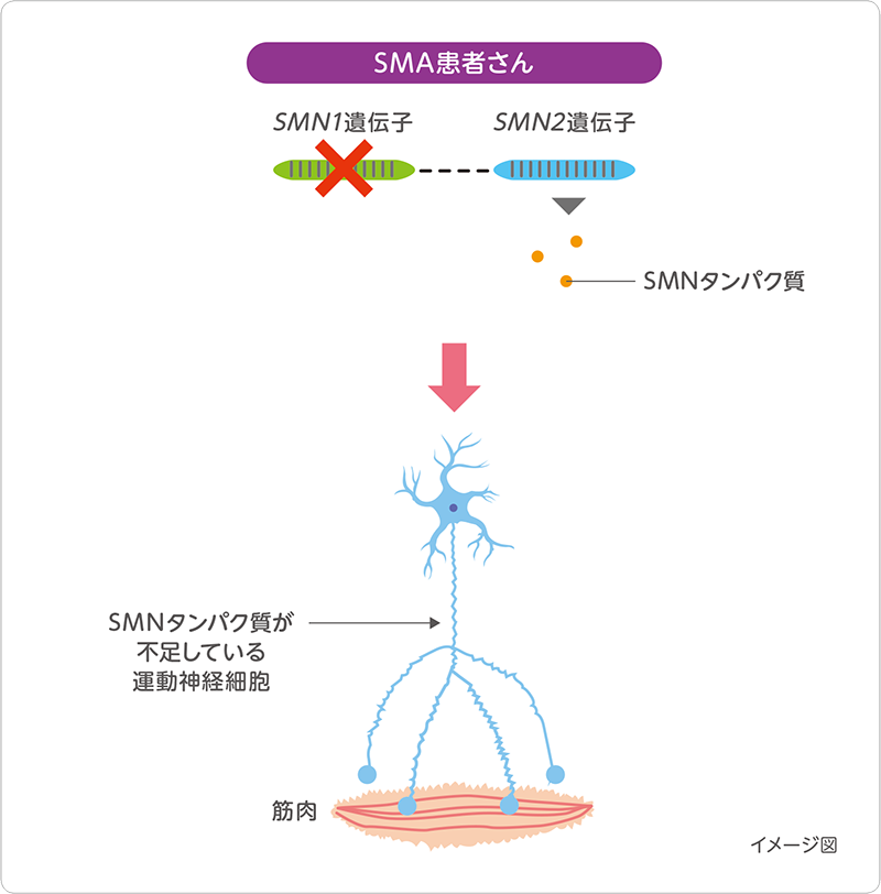 図：SMA患者さんの場合
