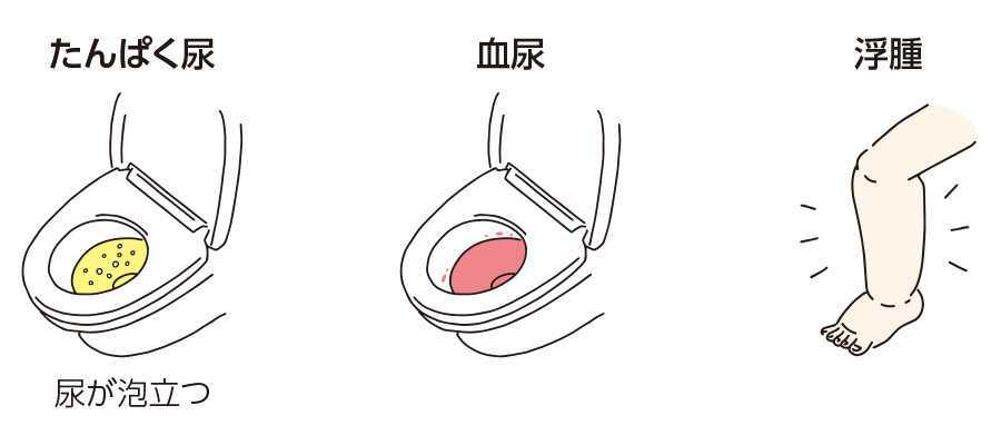 イラスト：たんぱく尿 尿が泡立つ、血尿、浮腫