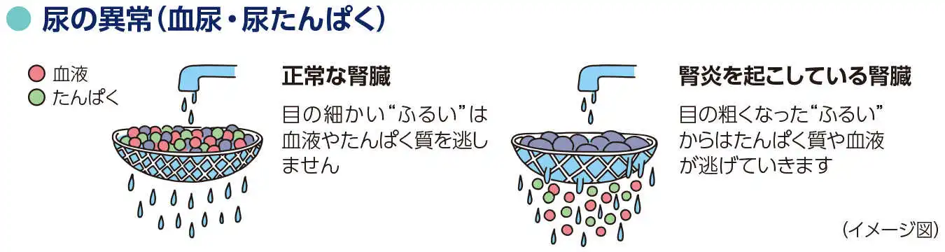 イメージ図：尿の異常（血尿・尿たんぱく） 正常な腎臓・目の細かい“ふるい”は血液やたんぱく質を逃しません。 腎炎を起こしている腎臓・目の粗くなった“ふるい”からはたんぱく質や血液が逃げていきます。