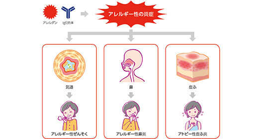イメージ：アレルギー性ぜんそくのしくみ
