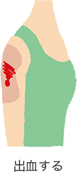 イメージ：出血するイラスト