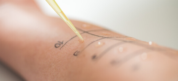 アレルギー検査（血液検査／皮ふテスト）