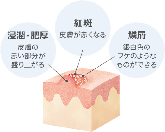 乾癬の皮膚症状