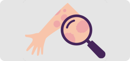 小児の乾癬（かんせん）について知りたい