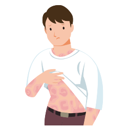 イメージ：紅皮症（剥脱性皮膚炎）のイラスト