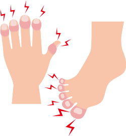 イメージ：手足の指の腫れのイラスト