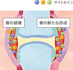 炎症性サイトカインによる骨の破壊と新たな形成