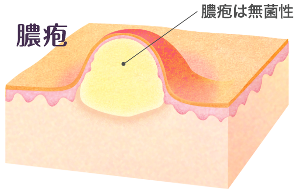 イメージ：膿疱のイラスト