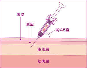 イメージ：皮ふの下にある脂肪層に注射します。 たるみがあって柔らかい部位を選ぶと比較的注射がしやすくなります。