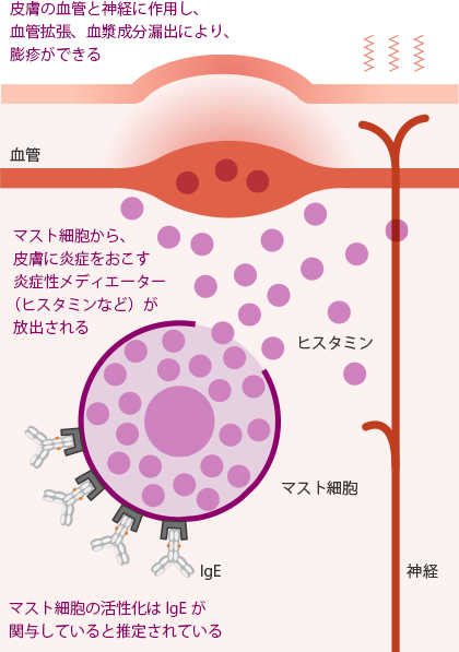 イメージ図：慢性蕁麻疹の病態