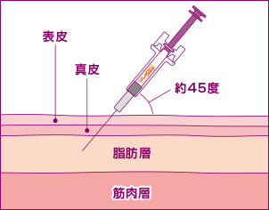 イメージ:皮ふの下にある脂肪層に注射します。 たるみがあって柔らかい部位を選ぶと比較的注射がしやすくなります。