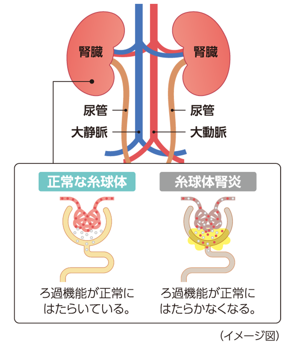 イメージ画像：C3腎症とは